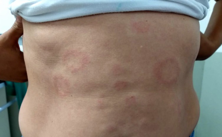 Hanseníase tem cura, procure uma Unidade Básica de Saúde em caso de sintomas ou suspeitas - Foto: SES/Governo do Tocantins